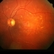 Fundus Flavimaculatus Fundus Flavimaculatus